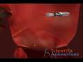 Cardiology Medical Animation - Deployment of mitral valve clip 