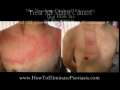 Natural remedy for Psoriasis ebook, 