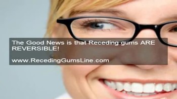 It's A Shame On You Not To Know This Much Regarding Receding Gums 