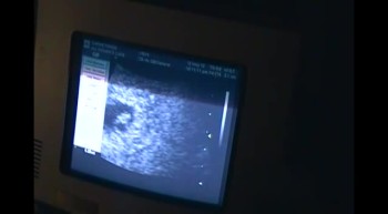 Abortion Survivor Carrie Fischer's 6 week ultrasound (with Heartbeat!!) 
