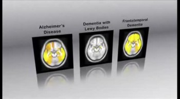 Imaging Dementia - Mayo Clinic 