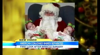 Conjoined Twins Get an Amazing Christmas Blessing 