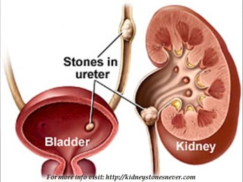 kidney stones symptoms 