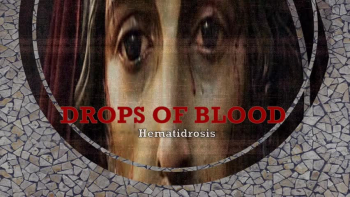DROPS OF BLOOD: Hematidrosis 