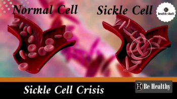 Sickle Cell Disease : SCD 