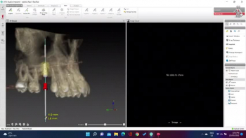 Prosthetically driven pilot drill surgical guide using DTX (Nobel) for a single missing tooth in less than 15 minutes<br /><br />Book an appointment on +61247218900 or 👩‍💻 👉 penrithdentalimplants.com.au/book-an-appointment/ today to receive an immediate emergency dental appointment.<br />#Find us on #Google🌏 https://goo.gl/maps/KbwsbANzW