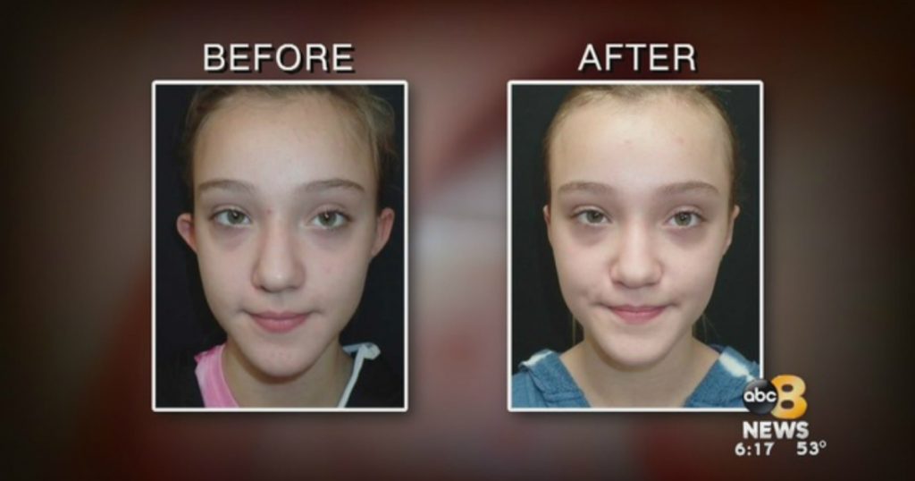 godupdates 11-year-old girl got cosmetic surgery after bullies mocked her ears 2