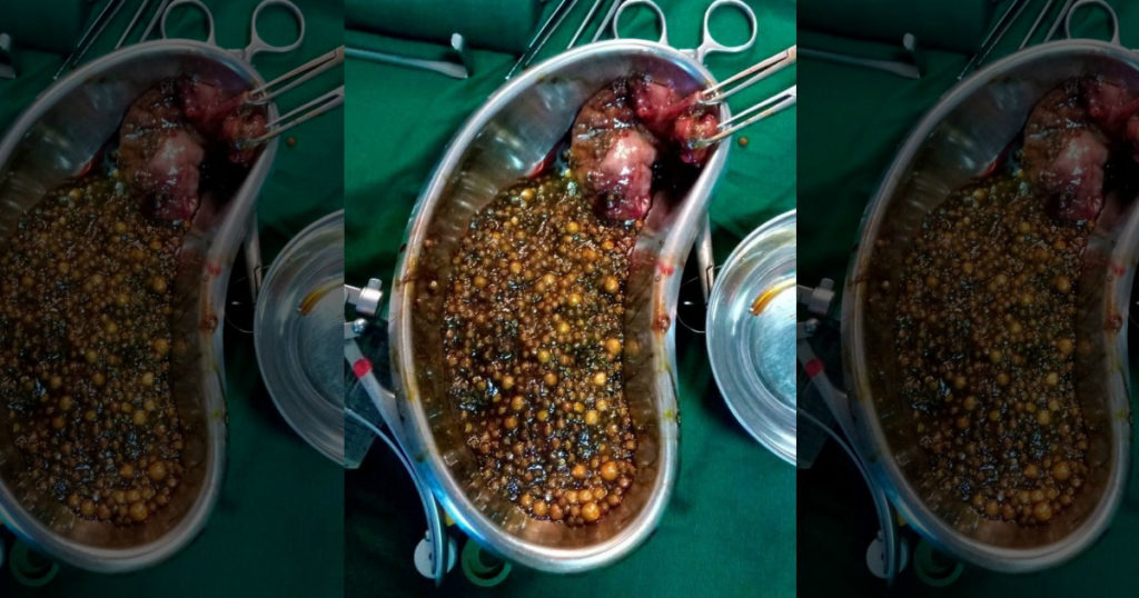 2350 gallstones removed 50-year-old woman