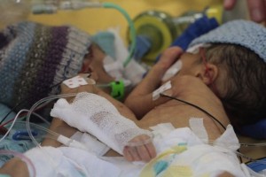 godupdates 8-day-old conjoined twins youngest to survive separation 1