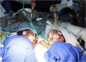 godupdates 8-day-old conjoined twins youngest to survive separation 4