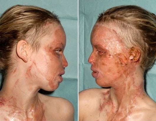 godupdates acid attack survivor katie piper 1