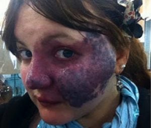 godupdates bullies turn her purple birthmark into cruel meme 7