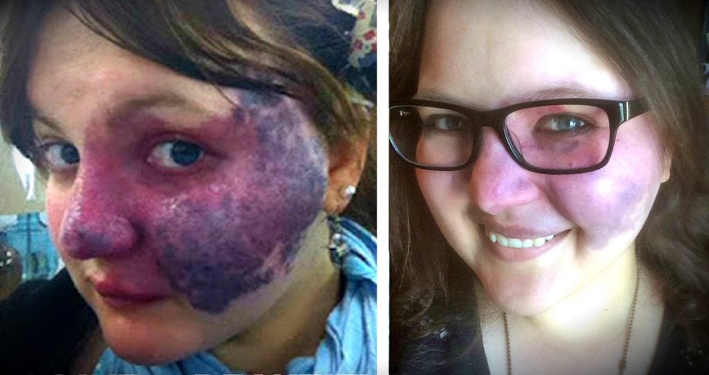 godupdates bullies turn her purple birthmark into cruel meme fb