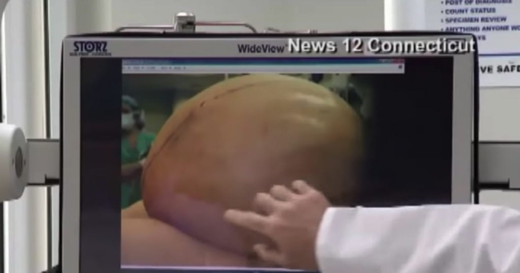 godupdates doctors remove 132-pound tumor from woman's ovary 1