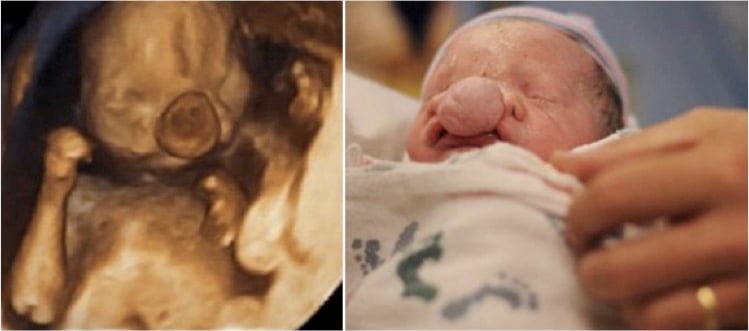 godupdates miracle baby brain growing outside skull 1