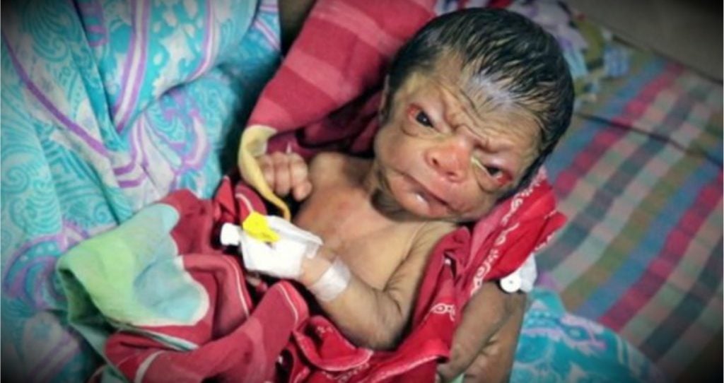 godupdates newborn resembles old man progeria fb