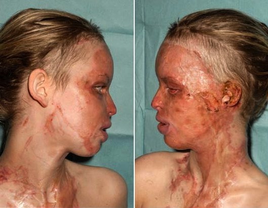 model katie piper acid attack