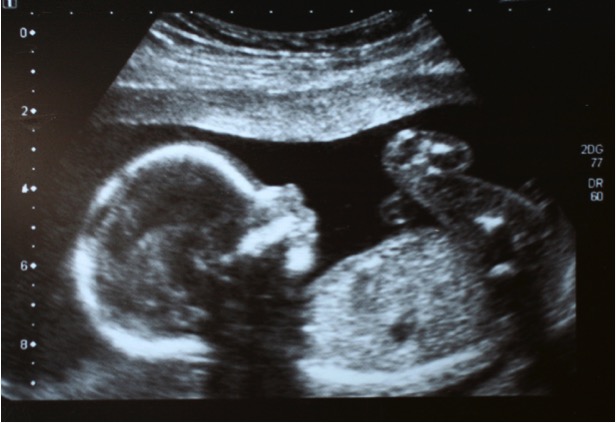 godvine mom stops abortion after seeing ultrasound