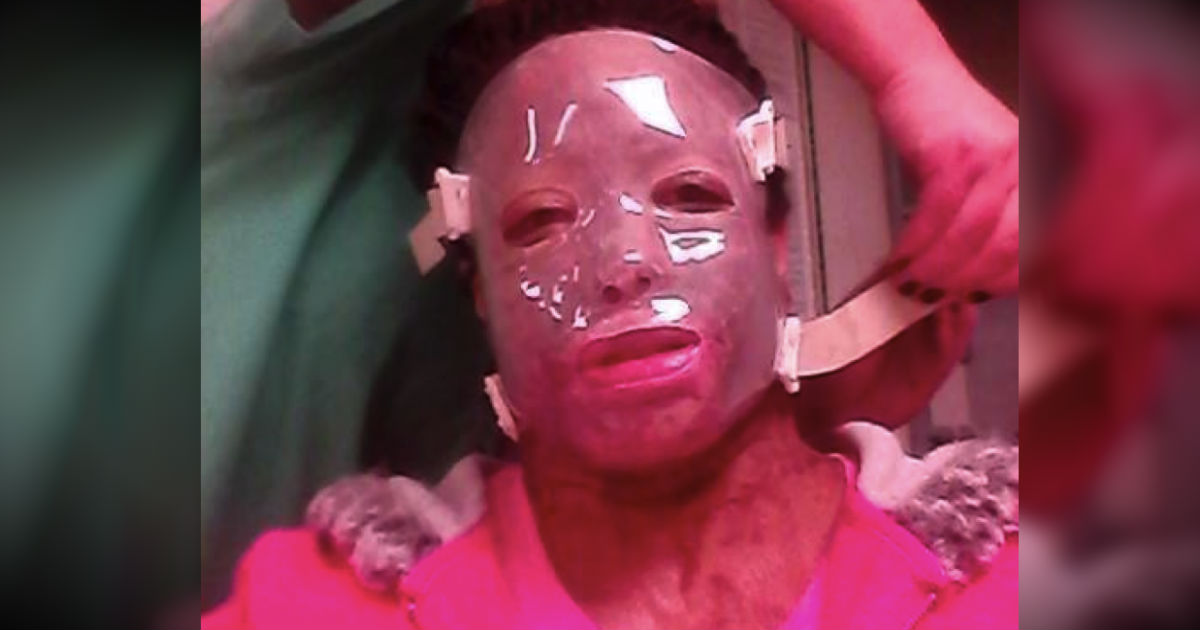 He Disfigured Her Face So No One Would Love Her. But This Survivor Is Using Her Story To Inspire!